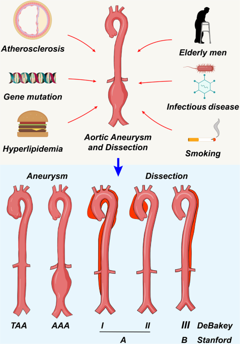 The mechanism and therapy of aortic aneurysms | Signal Transduction and  Targeted Therapy