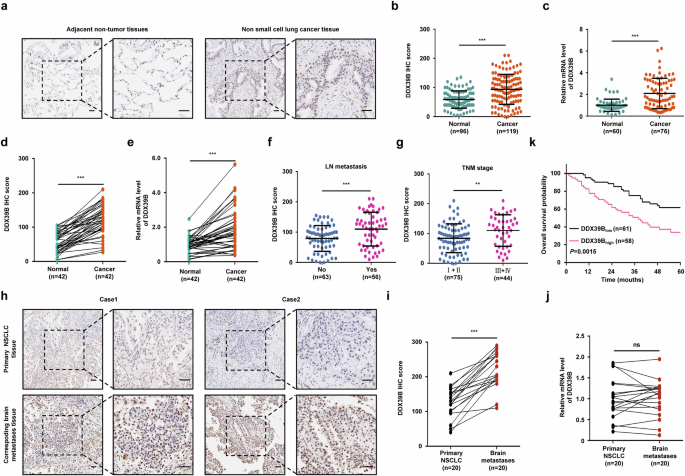 DDX39B K63-linked ubiquitination mediated by TRIM28 promotes NSCLC metastasis by enhancing ECAD lysosomal degradation