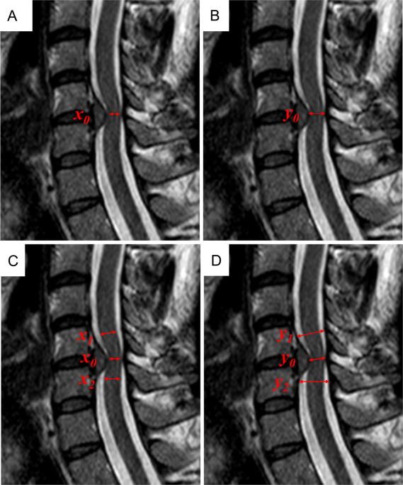 Assessment of degenerative cervical stenosis on T2-weighted MR imaging:  sensitivity to change and reliability of mid-sagittal and axial plane  metrics