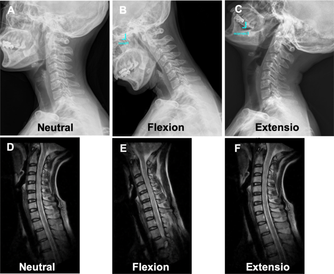 Correlation and reliability of cervical sagittal alignment
