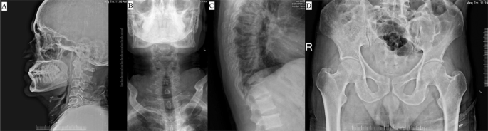 Complete paraplegia with diffuse osteolytic skeletal metastases: an uncommon presentation of carcinoma of the prostate