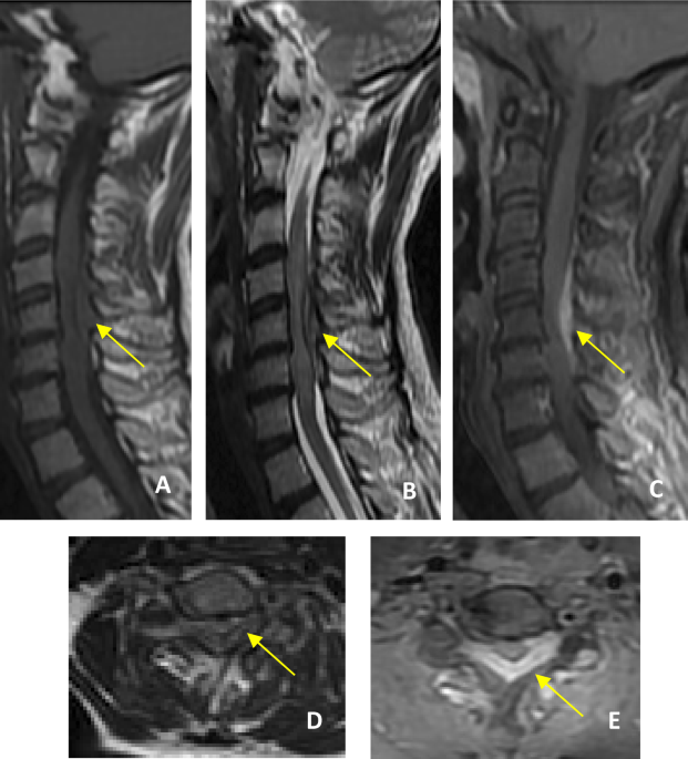Neurosyphilis revealed by compressive cervical spine syphilitic gumma: a  case report | Spinal Cord Series and Cases