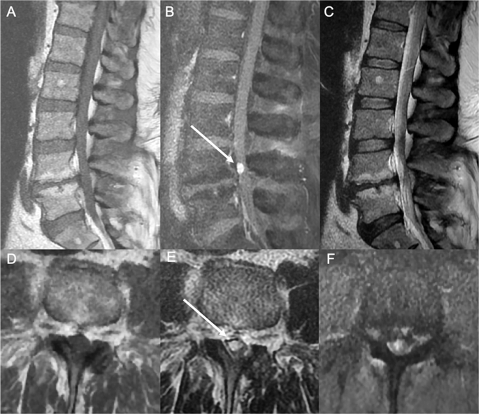 Intradural Extramedullary Capillary Hemangioma Of The Cauda Equina Case Report Of A Rare Spinal Tumor Spinal Cord Series And Cases