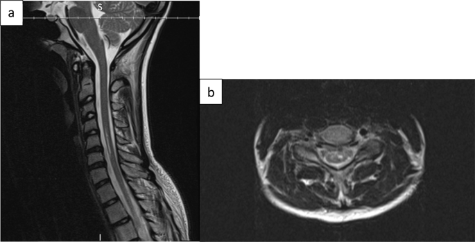 Fibrocartilagenous embolism case series: is it a zebra?