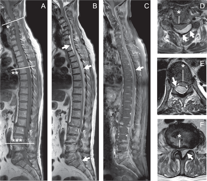 Skip decompression surgeries in the treatment of holospinal epidural abscess:  a case report | Spinal Cord Series and Cases