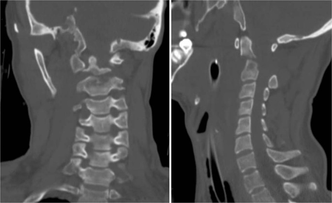 Odontoid and hangman fracture