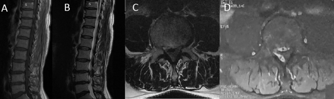 Lumbar spine epidural meningioma: report of a rare case | Spinal Cord  Series and Cases