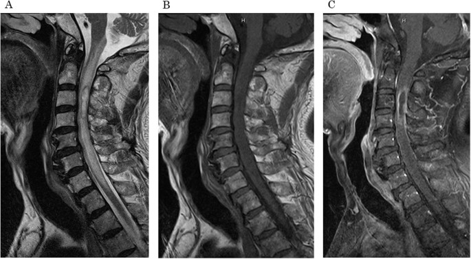 Intramedullary spinal cord abscess involving actinomyces and streptococcus: a case report and literature review