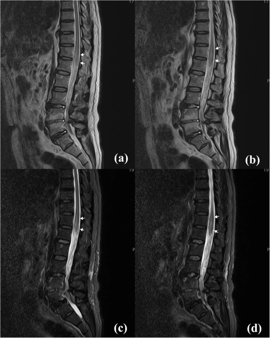 A report on neurogenic bladder in COVID-19 vaccine-associated acute transverse myelitis | Spinal Cord Series and ...