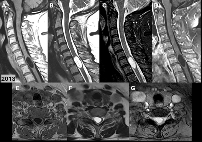 Spontaneous regression of post-traumatic syringomyelia: longitudinal mr imaging demonstrating a dynamic disease course