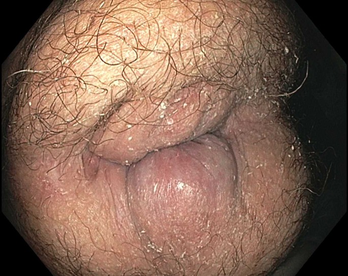 office management of hemorrhoids the american journal of