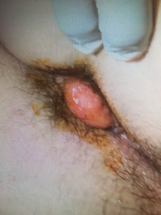 office management of hemorrhoids the american journal of