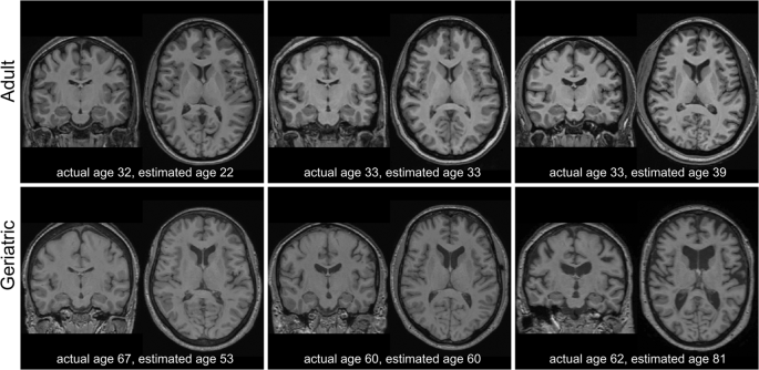 Brain age' screening for dementia