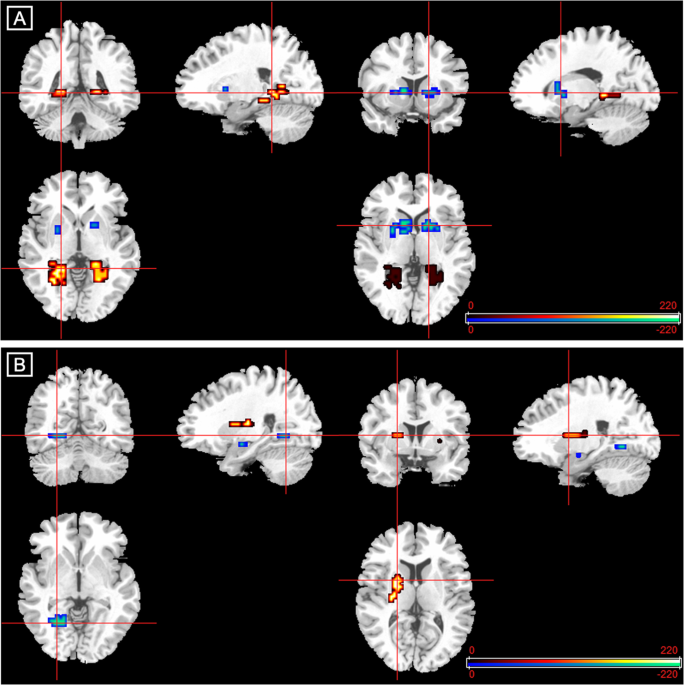 A single dose of cannabidiol modulates medial temporal and striatal  function during fear processing in people at clinical high risk for  psychosis | Translational Psychiatry