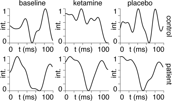 Fine-tuning neural for tailored ketamine use in treatment-resistant depression | Translational Psychiatry