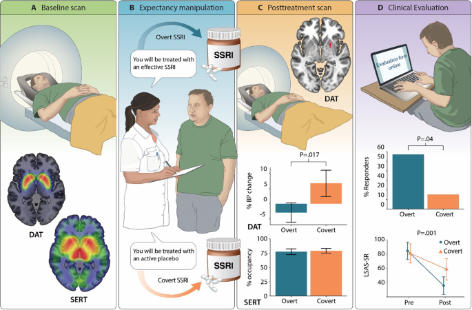 tirzepatide and ssri Expectancy effects on serotonin and dopamine transporters during SSRI  treatment of social anxiety disorder: a randomized clinical trial