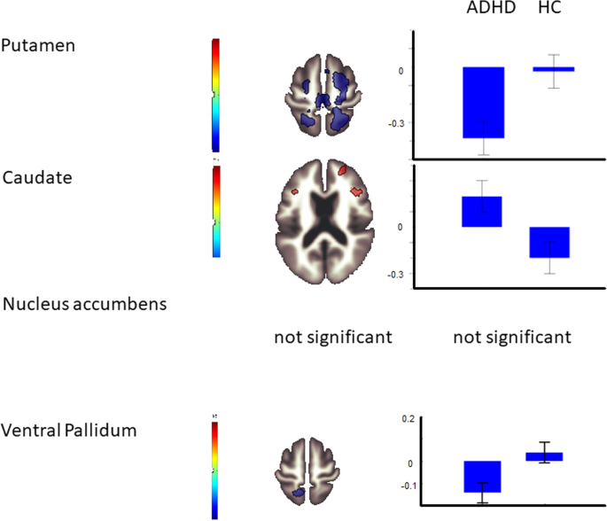 Is genetic risk of ADHD mediated via dopaminergic mechanism? A 