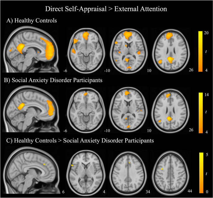 A brain model of altered self-appraisal in social anxiety disorder | Translational Psychiatry - Natu