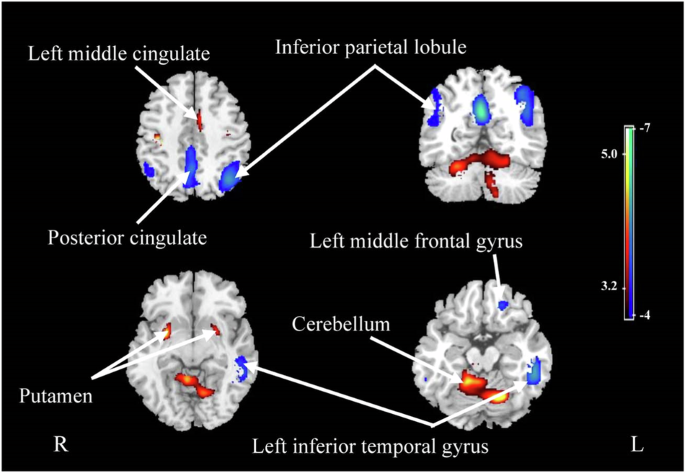 Associations of plasma biomarkers with cerebral perfusion and structure in Alzheimer’s disease