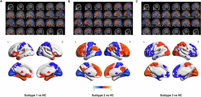 Depression Subtypes Dissecting biological heterogeneity in major depressive disorder based ...