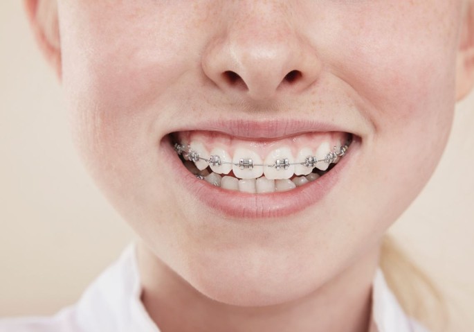 Orthodontic reprocurement | BDJ In Practice