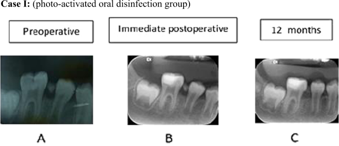 Clinical and radiographic evaluation of indirect pulp treatment of young  permanent molars using photo-activated oral disinfection versus calcium  hydroxide: a randomized controlled pilot trial | BDJ Open