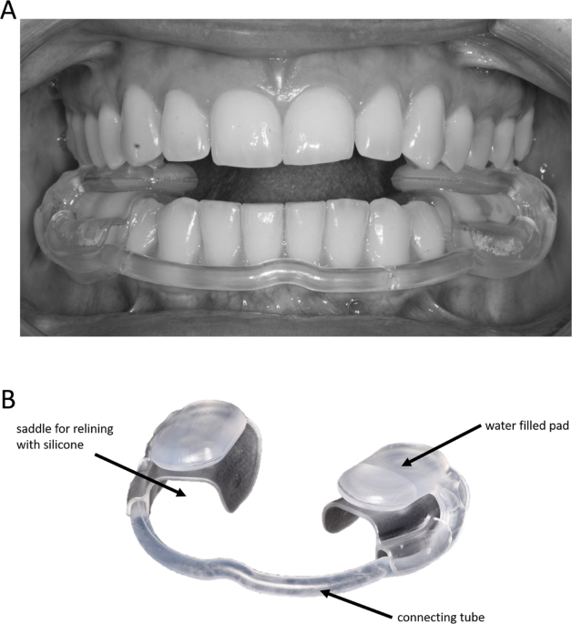 Patients' perceptions on temporomandibular disorder treatment with  hydrostatic oral splints - a pilot study | BDJ Open
