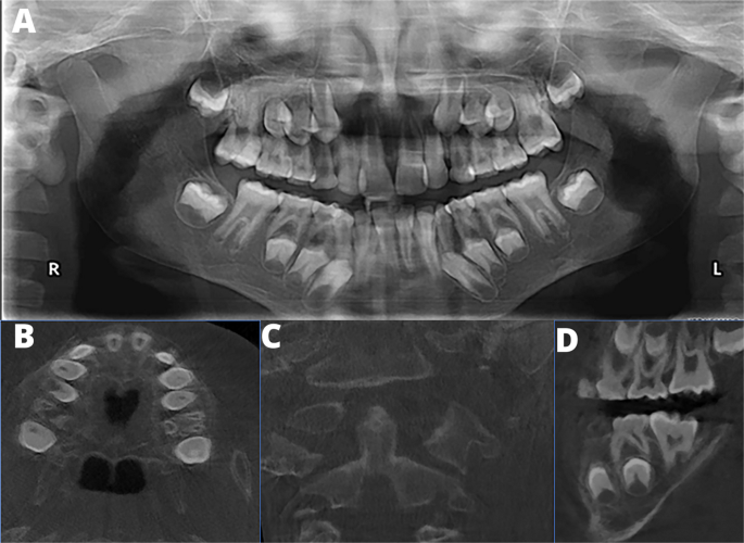 Craniometaphyseal dysplasia radiology