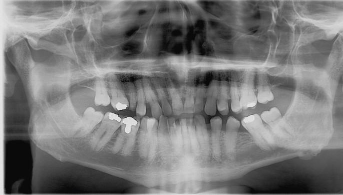 Inverted X-Ray make-up challenge 