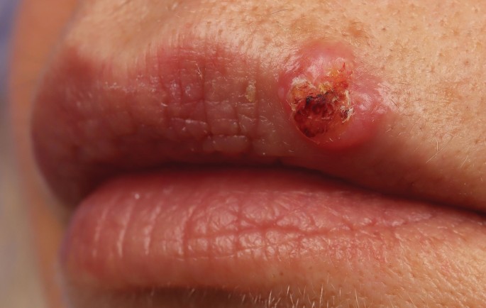 health effects of smoking tobacco Health effects of smoking tobacco