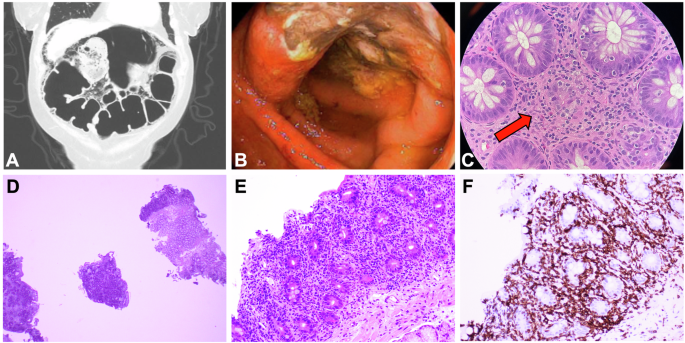 Immune effector cell-associated enterocolitis following chimeric ...