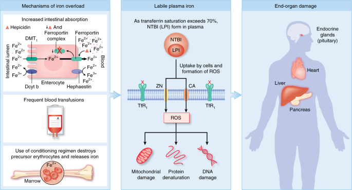 Iron overload in the HCT patient: a review | Bone Marrow Transplantation Iron overload in the HCT patient: a review | Bone Marrow Transplantation