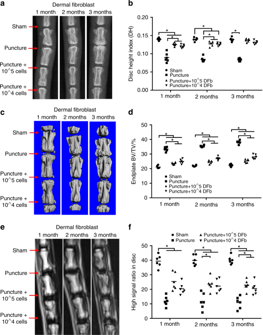 Autologous fibroblasts induce fibrosis of the nucleus pulposus to maintain  the stability of degenerative intervertebral discs