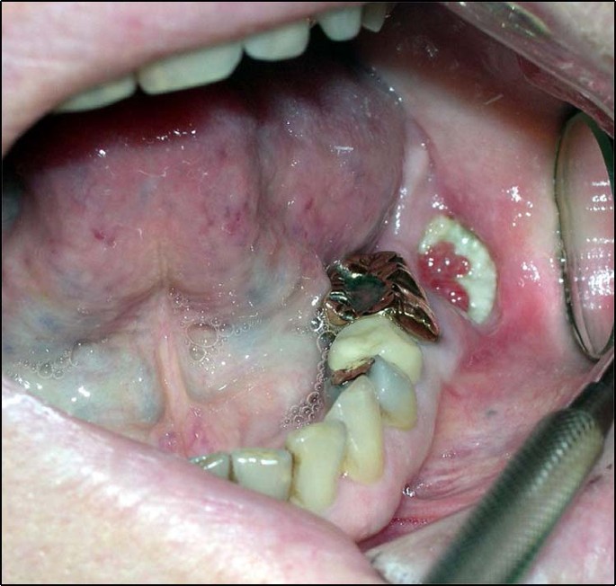 Mitigating Osteonecrosis Of The Jaw Onj Through Preventive Dental Care And Understanding Of Risk Factors Bone Research Mitigating Osteonecrosis Of The Jaw Onj Through Preventive Dental Care And Understanding Of Risk Factors Bone Research