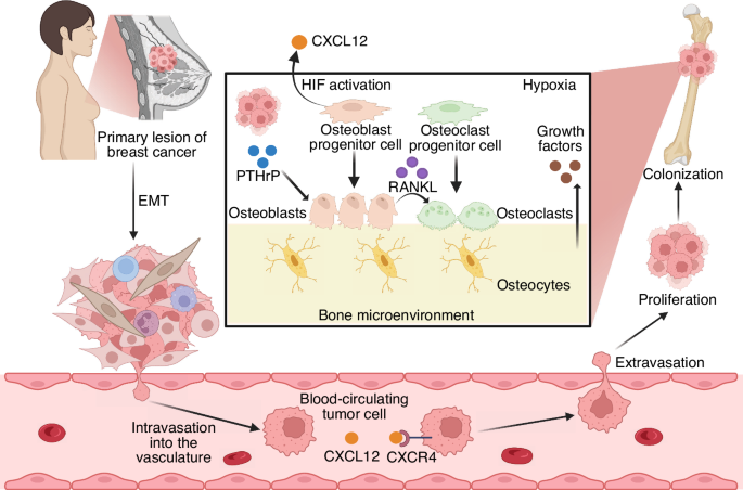 Breast Tumors Recruit Bone Cells to Boost Growth