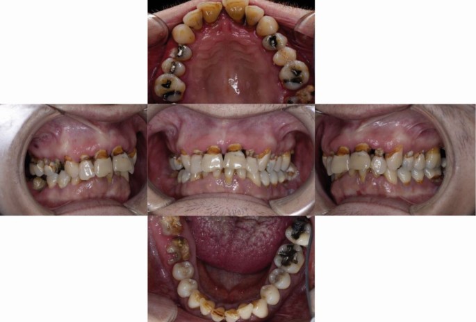 Oral Healthcare Management In Heroin And Methadone Users British Dental Journal