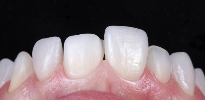 Definitive veneers and crowns prepared digitally using prosthetic