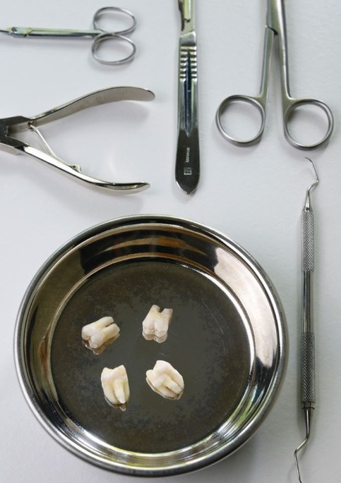 To extract or not to extract: examining the referrals for third molar removal