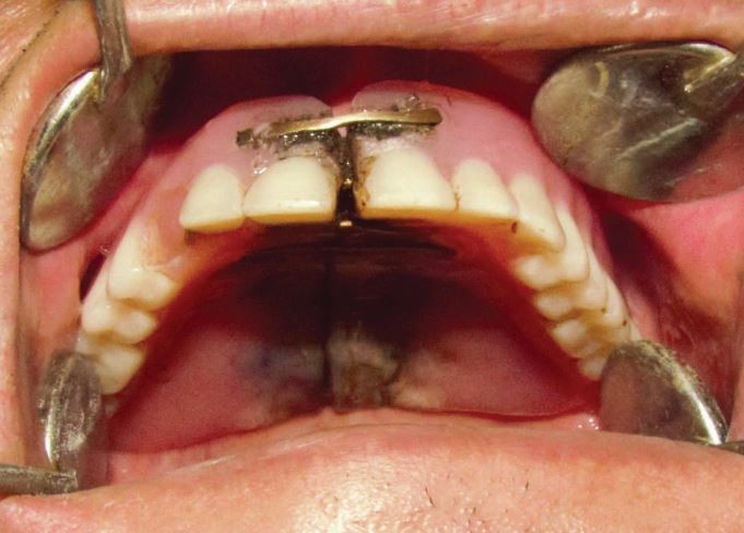 Self Repaired Denture British Dental Journal