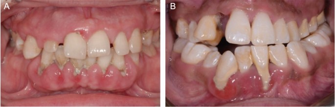 Systemic disease or periodontal disease? Distinguishing causes of gingival  inflammation: a guide for dental practitioners. Part 1: immune-mediated,  autoinflammatory, and hereditary lesions | British Dental Journal