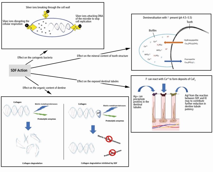 The Use Of Silver Diamine Fluoride Sdf In Dental Practice British Dental Journal The Use Of Silver Diamine Fluoride Sdf In Dental Practice British Dental Journal
