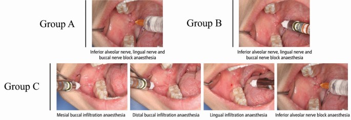 The Mandibular Nerve Block Anatomy The mandibular