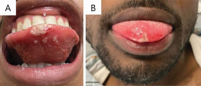 Update on Monkeypox - Dimensions of Dental Hygiene