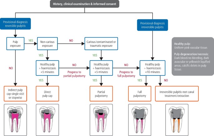 Minimally invasive endodontics: a new era for pulpotomy in mature