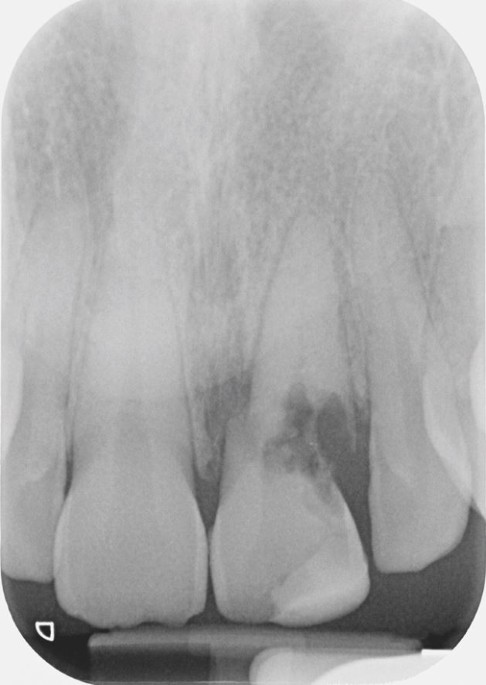 A dental trauma case in a snowy day - AbuMaizar Dental Roots Clinic