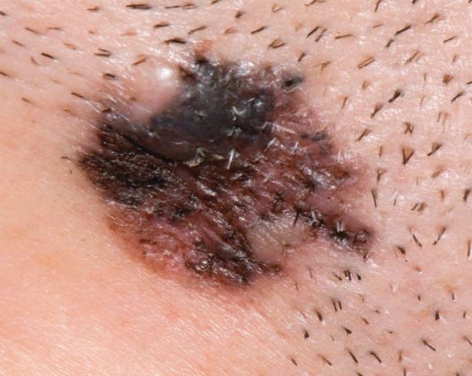 Skin cancer - what general dental practitioners should look for