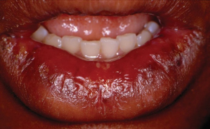common side effects of melanotan ii a HARD EARNED TAN follow up , if you know you know , #medicine #health  #wellness #science #life