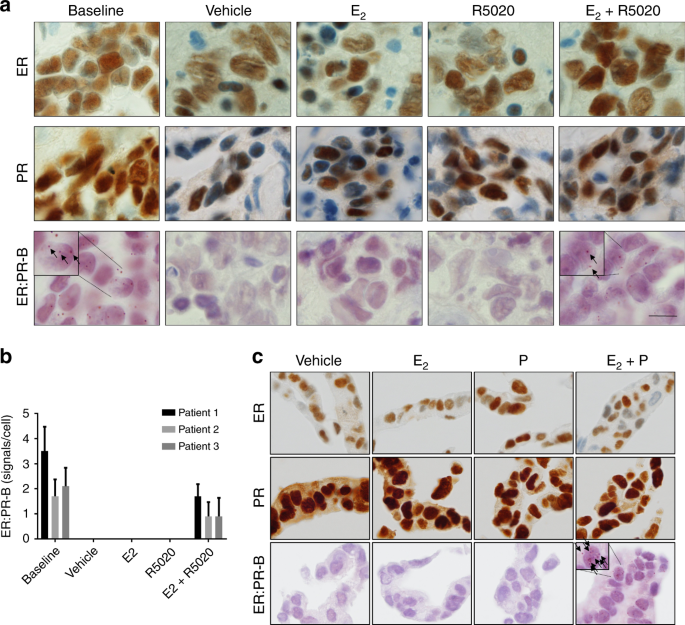 Improved relapse-free survival on aromatase inhibitors in breast cancer is associated with interaction between oestrogen receptor-α and progesterone receptor-b