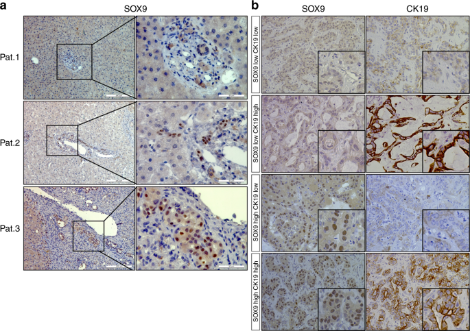 Sox9 expression decreases survival of patients with intrahepatic cholangiocarcinoma by conferring chemoresistance