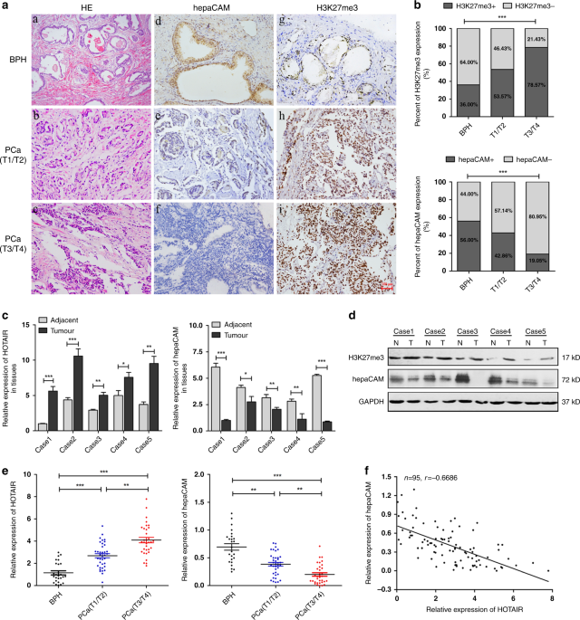 Long noncoding rna hotair regulates the invasion and metastasis of prostate cancer by targeting hepacam